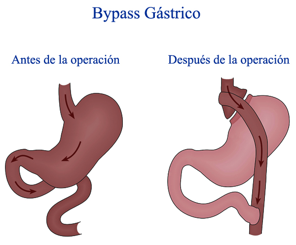 Bypass Gástrico