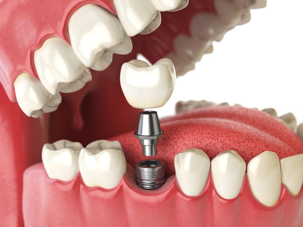 Implante dental - esquema