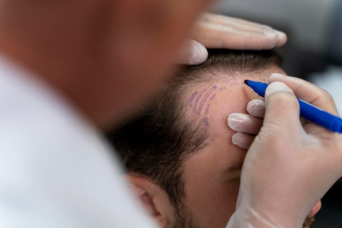 Médico marcando la zona receptora antes de un injerto capilar