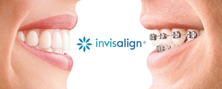 Invisalign
